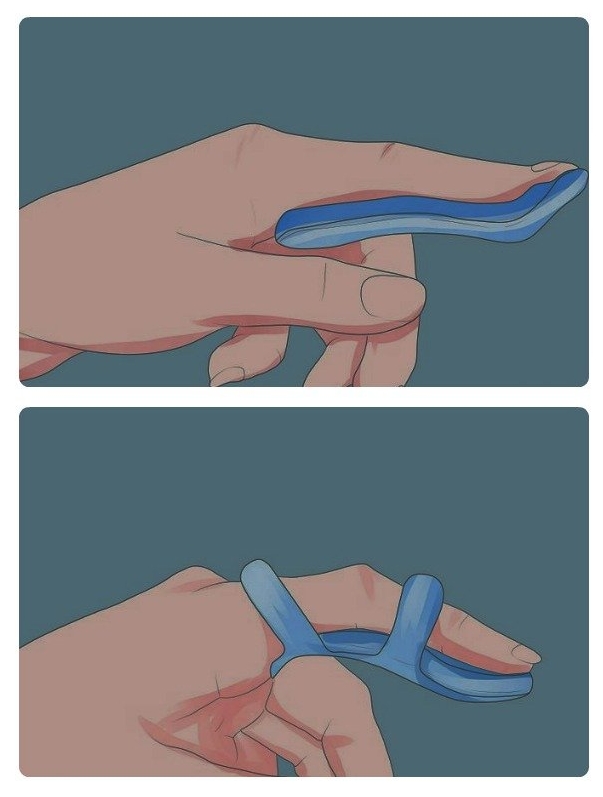 Иммобилизация с помощью шины Иммобилизация с помощью шины