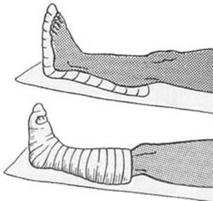 Иммобилизация стопы Иммобилизация стопы
