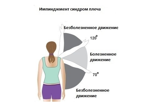 Боль при импинджмент–синдроме плечевого сустава Боль при импинджмент–синдроме плечевого сустава