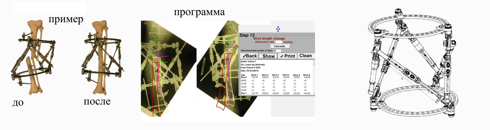 Индивидуальная конструкция аппарата Илизарвоа Индивидуальная конструкция аппарата Илизарвоа
