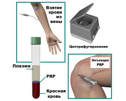 Инъекции PRP Инъекции PRP