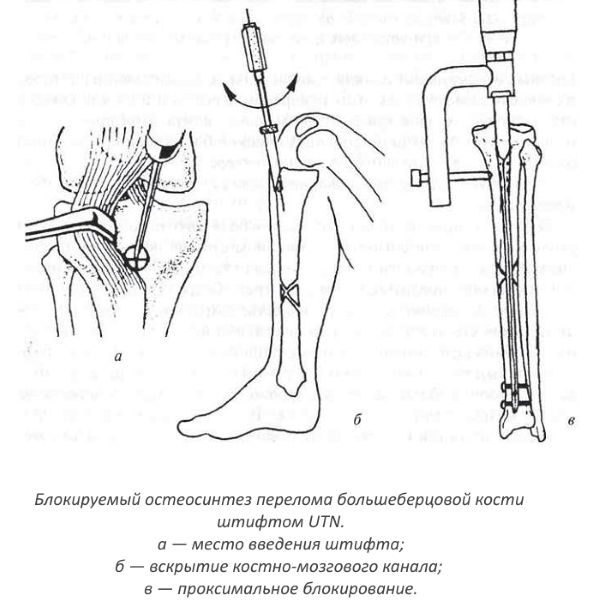 Интрамедуллярный блокирующий остеосинтез Интрамедуллярный блокирующий остеосинтез