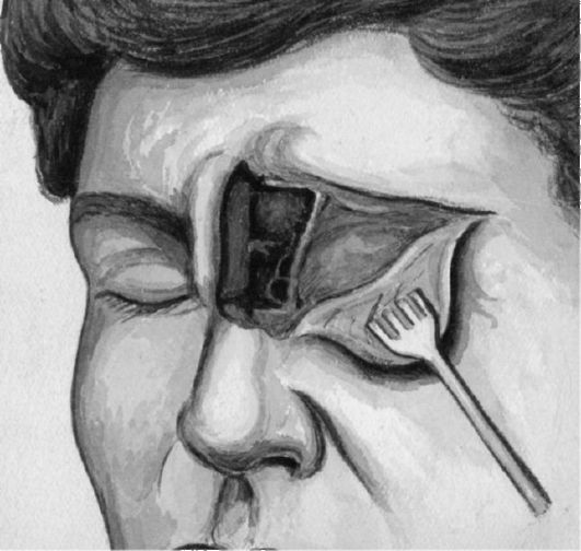 Открытое иссечение остеомы лобной пазухи Открытое иссечение остеомы лобной пазухи