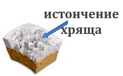 Истончение хряща