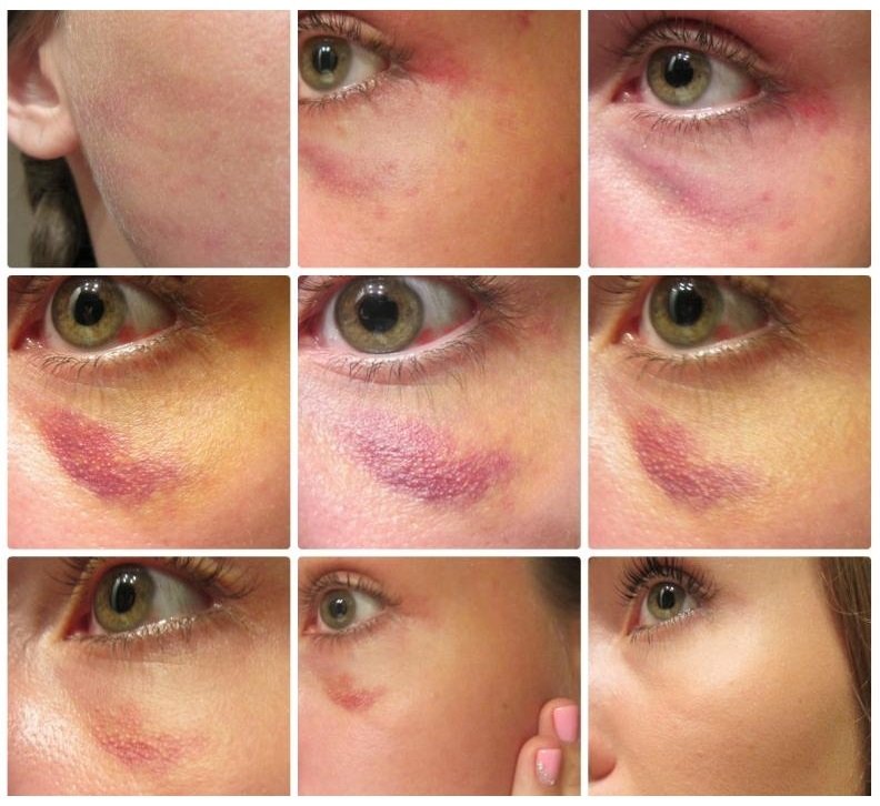 Избавление от гематомы Избавление от гематомы