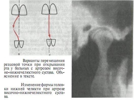 Изменения при вчнс при артрозе на артрографии Изменения при вчнс при артрозе на артрографии