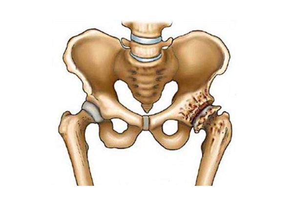 Изнашивание тазобедренного сустава Изнашивание тазобедренного сустава
