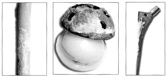 Износ протеза тазобедренного сустава Износ протеза тазобедренного сустава