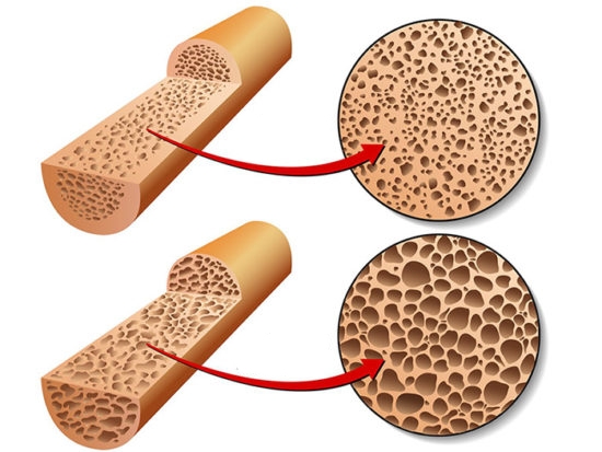 Изучение плотности костей Изучение плотности костей
