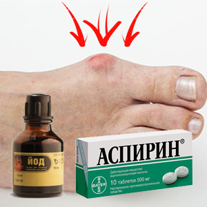Йод с аспирином при подагре Йод с аспирином при подагре
