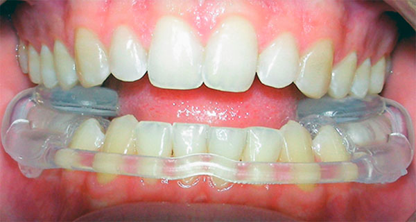 Капа при вывихе челюсти