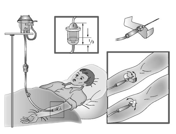 Капельное введение раствора Капельное введение раствора