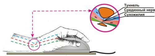 Неправильное положение руки при работе Неправильное положение руки при работе
