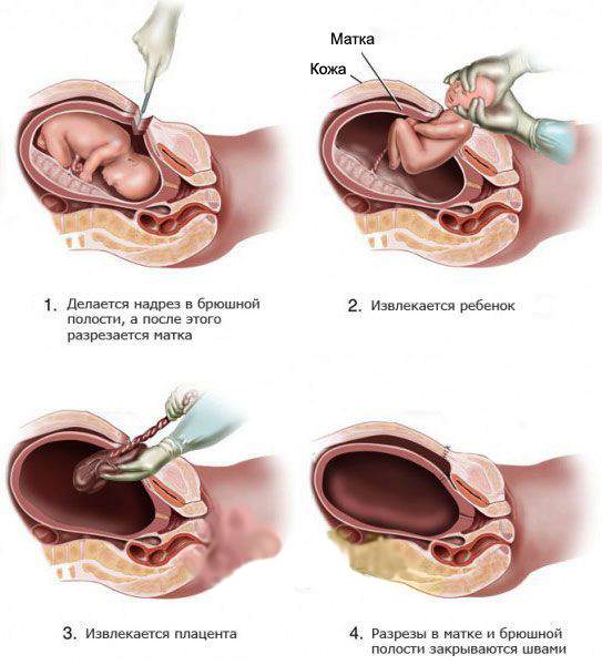 Кесарево сечение при сильной грыже позвоночника Кесарево сечение при сильной грыже позвоночника