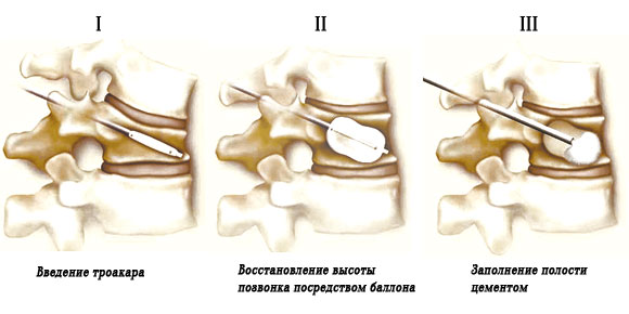 Этапы кифопластики Этапы кифопластики
