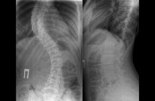 Кифосколиоз на рентген снимке Кифосколиоз на рентген снимке