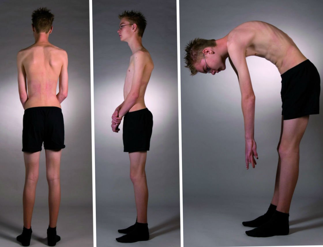 Деформация спины при кифозе