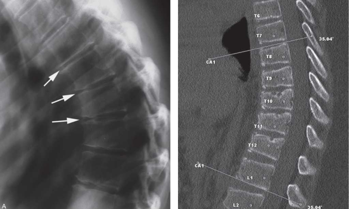 Кифоз на МРТ и рентген снимке Кифоз на МРТ и рентген снимке