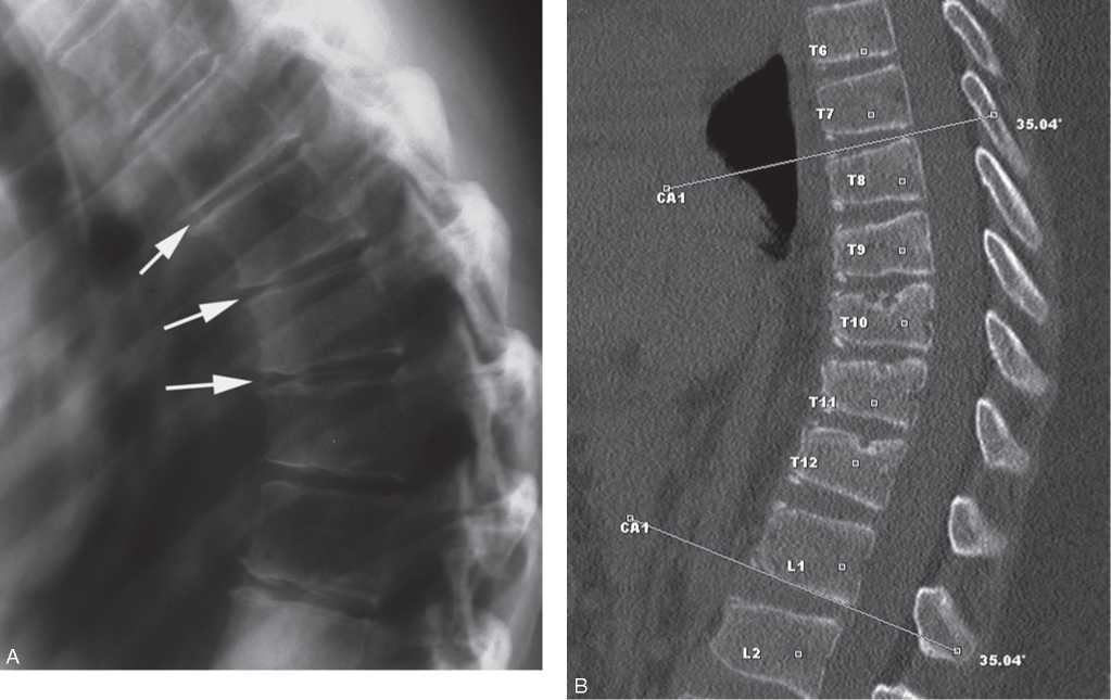 Кифоз на рентген снимке Кифоз на рентген снимке