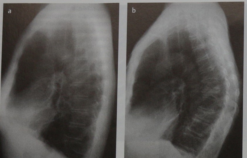 Кифоз на рентген снимке Кифоз на рентген снимке