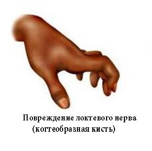 Кисть при повреждении локтевого нерва Кисть при повреждении локтевого нерва