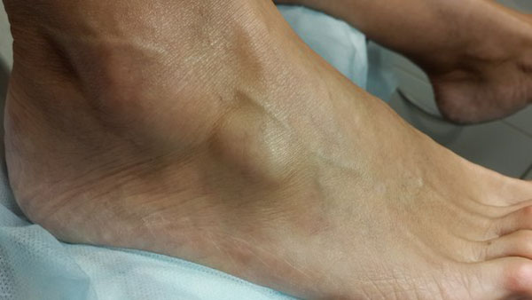 Визуальное проявление кисты голеностопа