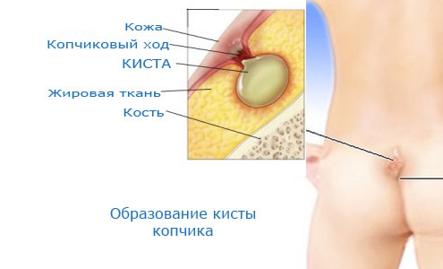 Киста копчика Киста копчика