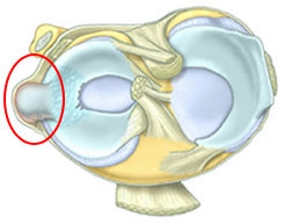 Киста мениска Киста мениска