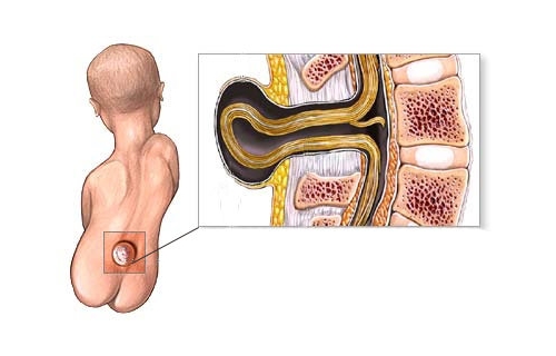 Проявление кисты позвоночника у новорожденного Проявление кисты позвоночника у новорожденного