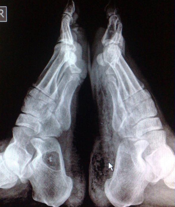 Кисты пятки на МРТ снимке Кисты пятки на МРТ снимке