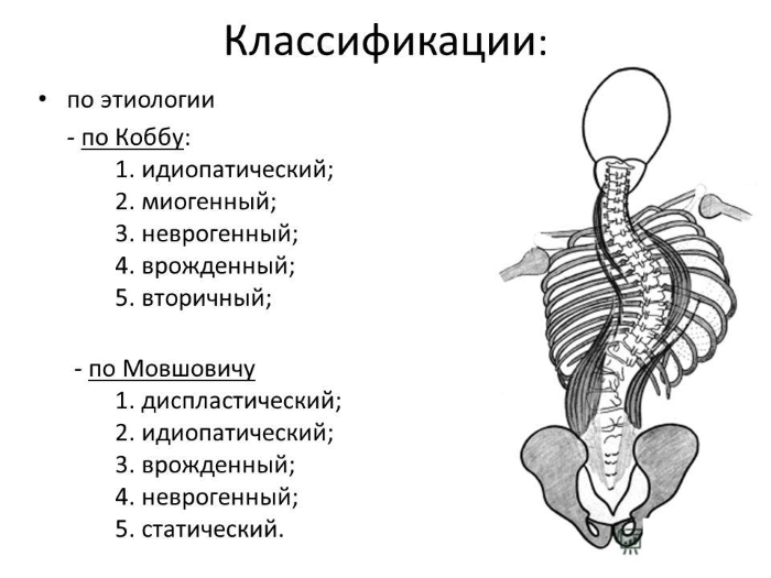 Классификации сколиоза по Коббу и Мовшовичу Классификации сколиоза по Коббу и Мовшовичу