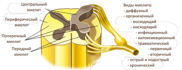 Классификация миелита Классификация миелита