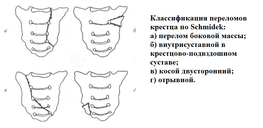 Классификация переломов крестца по Шмидек Классификация переломов крестца по Шмидек