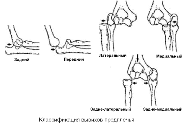 Классификация вывиха предплечья