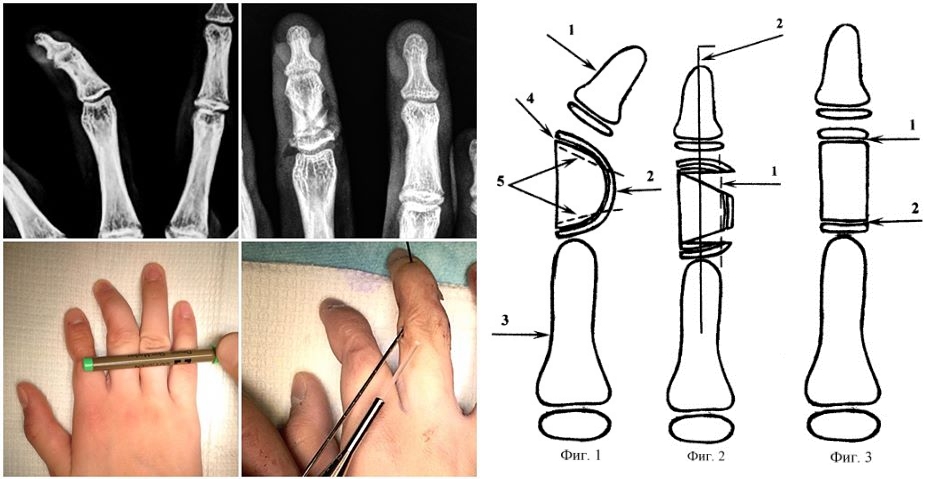 Хирургическое выравнивание клинодактилии Хирургическое выравнивание клинодактилии