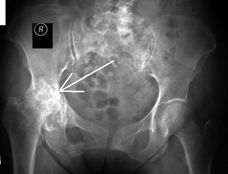 Коксартроз на рентген снимке Коксартроз на рентген снимке