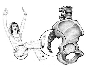 Кокцигодиния на фоне травмы Кокцигодиния на фоне травмы