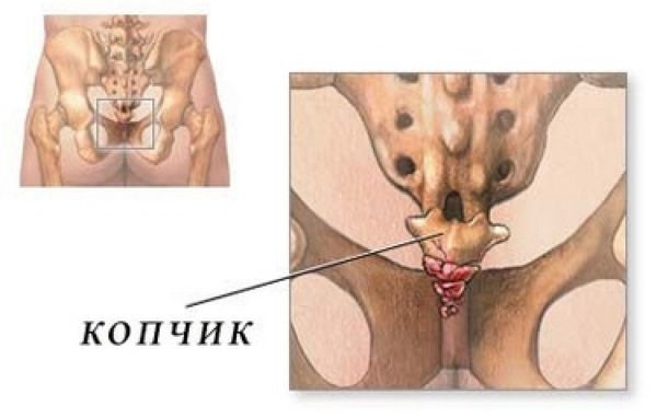 Боль в копчике сидя Кокцидогония копчика