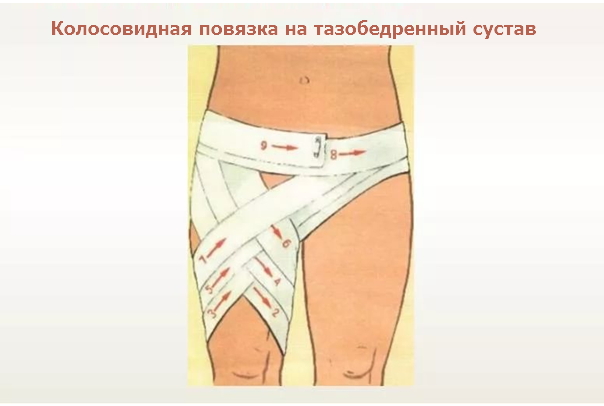 Колосовидная повязка на тазобедренный сустав