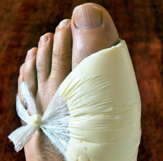 Компресс при подагре с кашицей лука и чеснока Компресс при подагре с кашицей лука и чеснока