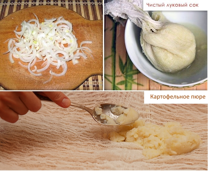 Компрессы с луком и картофелем Компрессы с луком и картофелем