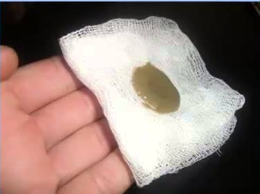 Компресс с мазью Вишневского Компресс с мазью Вишневского