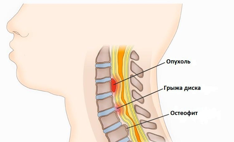 Компрессионная миелопатия Компрессионная миелопатия