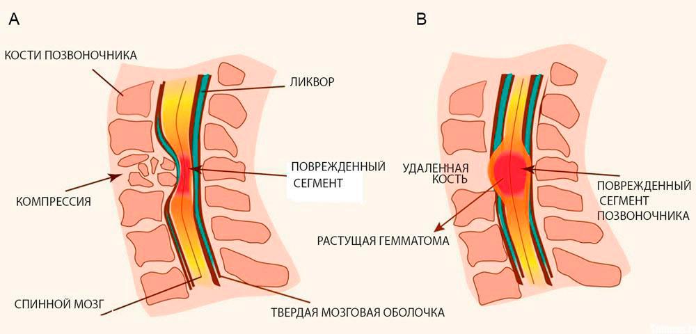 Компрессия спинного мозга Компрессия спинного мозга