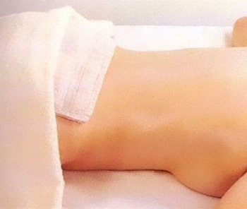 Применение компрессов при ишиасе Применение компрессов при ишиасе