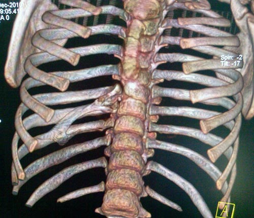 Конкресценция на КТ Конкресценция на КТ