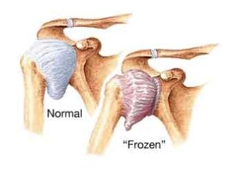 Контрактура плечевого сустава Контрактура плечевого сустава