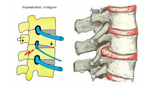 Боль при корешковом синдроме Боль при корешковом синдроме