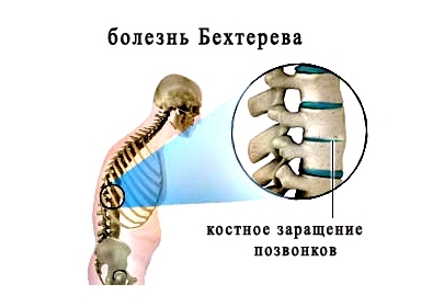 Костное заращение позвонков при спондилите Костное заращение позвонков при спондилите