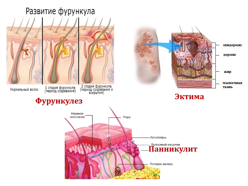 Возможные кожные заболевания на ягодицах Возможные кожные заболевания на ягодицах